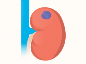 Kidney Cancer: The Silent Disease